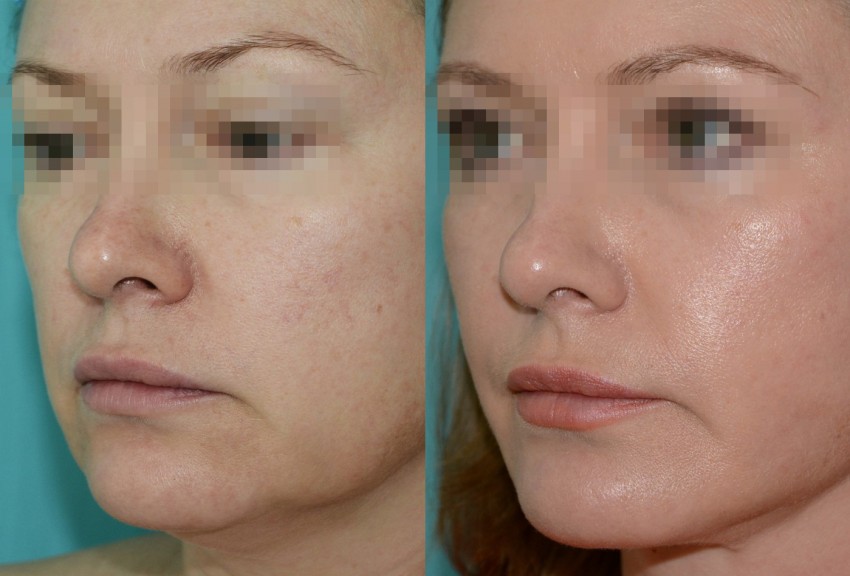 Брыли на лице фото до и после липолитики для лица щеки
