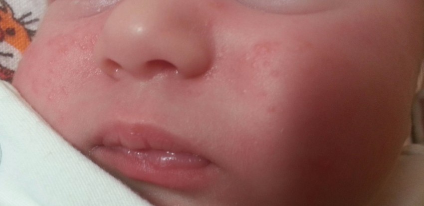 Аллергическая сыпь у детей: как выглядит и почему появляется сыпь у детей разных возрастов. Лечение и профилактика аллергии у детей (140 фото)