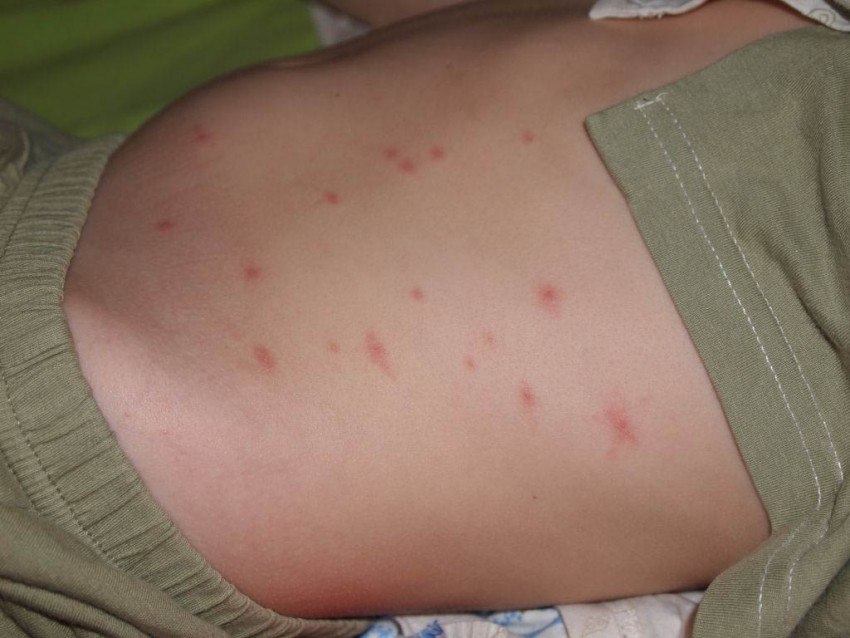 Аллергическая сыпь у детей: как выглядит и почему появляется сыпь у детей разных возрастов. Лечение и профилактика аллергии у детей (140 фото)