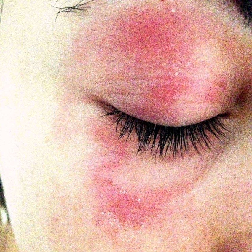 Аллергическая сыпь у взрослых: 110 фото проявлений, симптомы, определение аллергена и советы по выбору лекарства