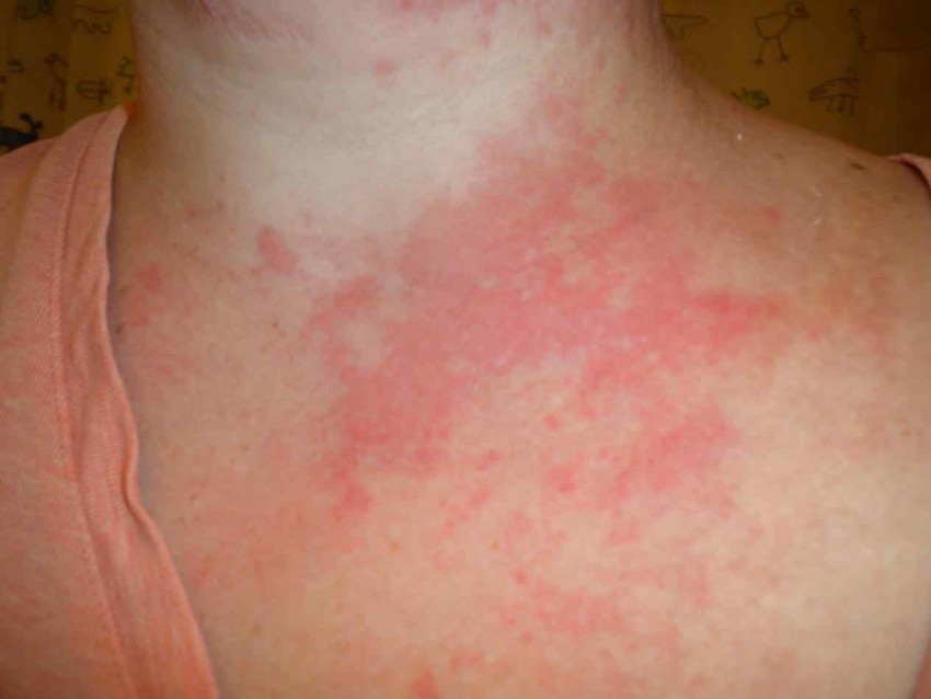 Аллергическая сыпь у взрослых: 110 фото проявлений, симптомы, определение аллергена и советы по выбору лекарства