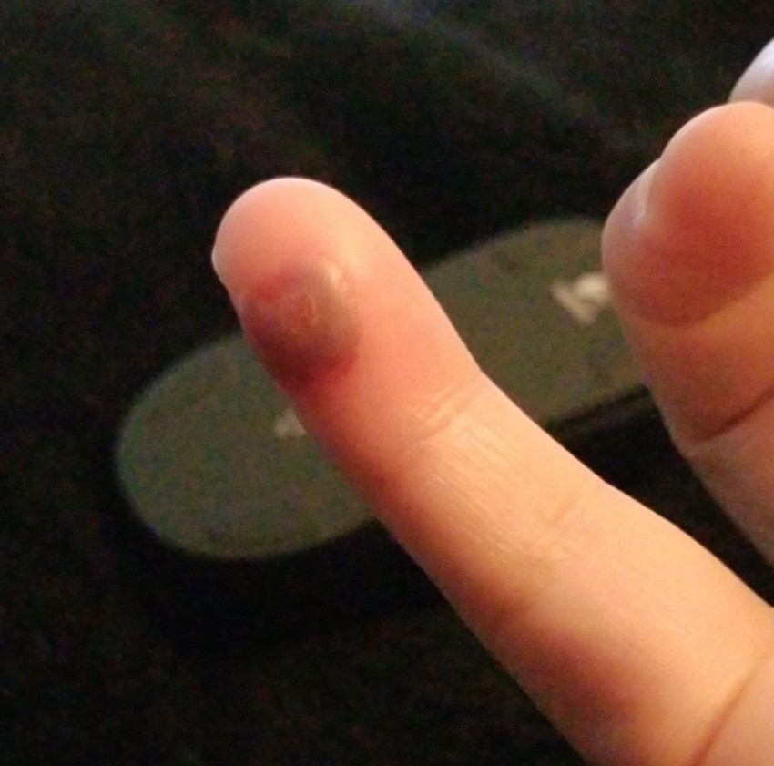 Бородавка на пальце: чем лечить, как удалить и к какому врачу следует обращаться с этой проблемой (115 фото)