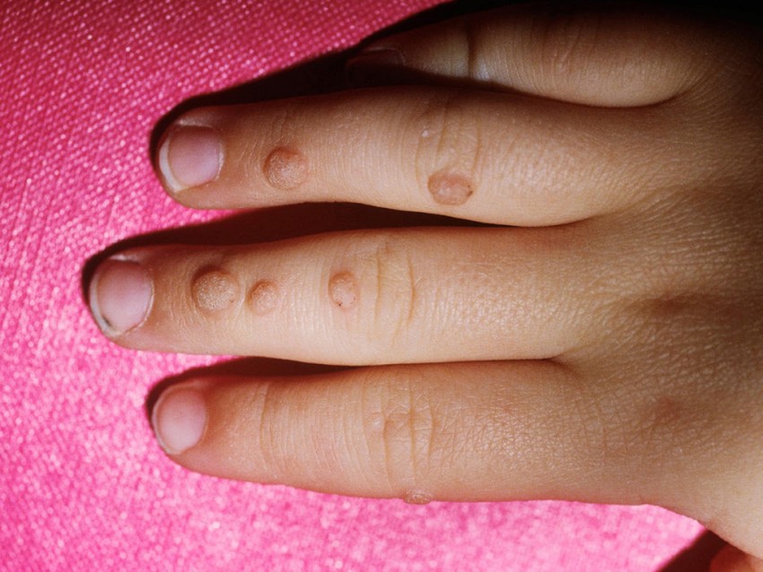 Бородавка на пальце: чем лечить, как удалить и к какому врачу следует обращаться с этой проблемой (115 фото)