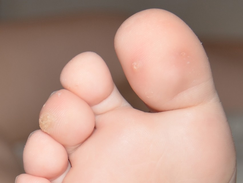 Бородавка на пальце ноги - причины появления, симптомы и удаление. 95 фото бородавок и видео лечения заболевания