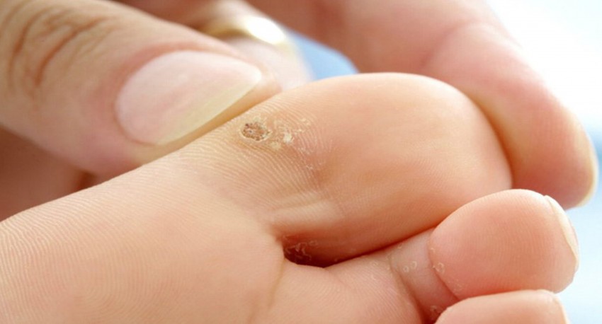 Бородавка на пальце ноги - причины появления, симптомы и удаление. 95 фото бородавок и видео лечения заболевания