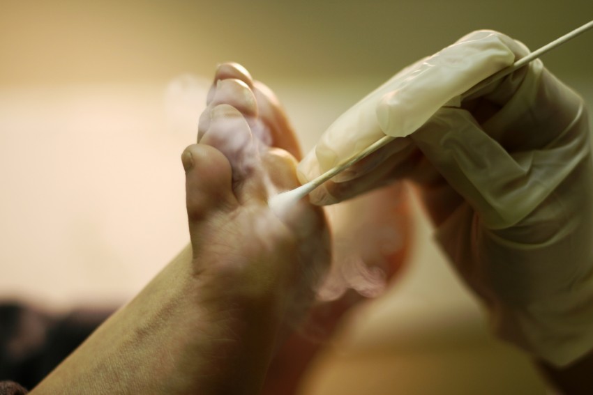 Бородавки на ногах: к какому врачу обращаться и советы по выбору лечения. Как убрать бородавку своими руками (105 фото)