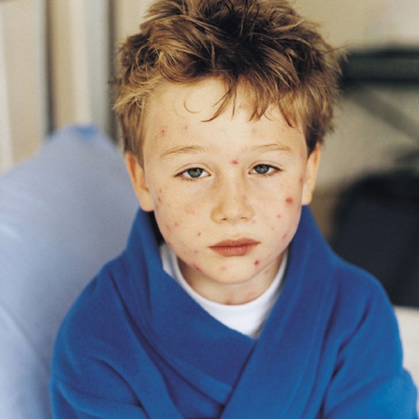 Герпесные инфекции у детей фото сыпи