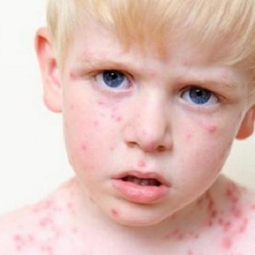 Герпесные инфекции у детей фото сыпи