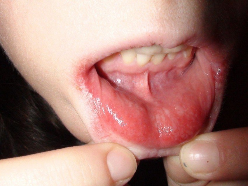 Герпесвирусная инфекция у детей фото сыпи