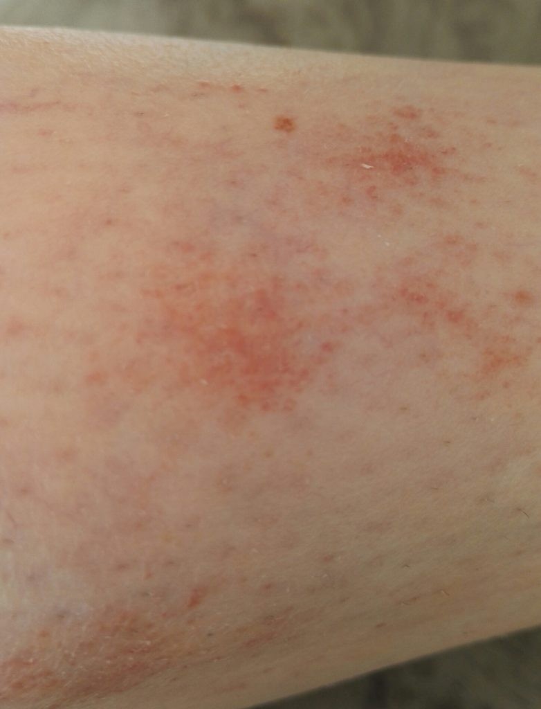 Что такое гиперемия кожи лечение в домашних условиях