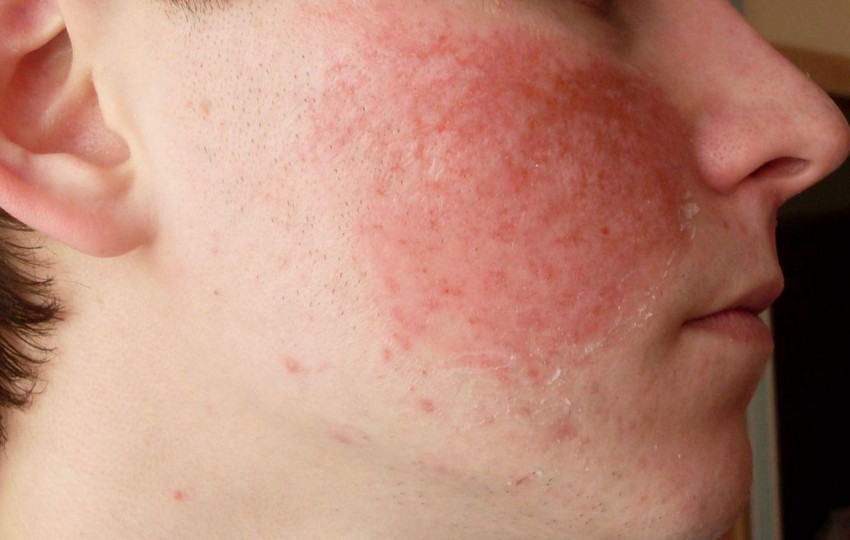 Что такое гиперемия кожи лечение в домашних условиях