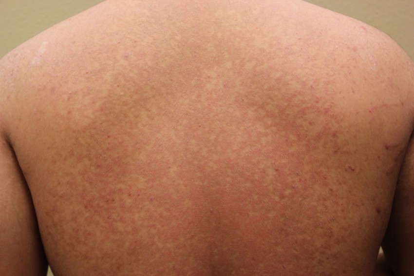 Грибок кожи на теле человека: фото, лечение мазями