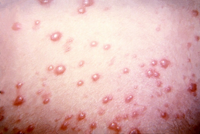Аллергия грибок на коже фото