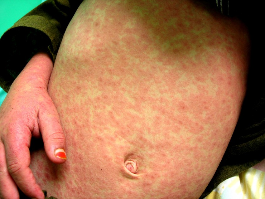 Аллергия грибок на коже фото
