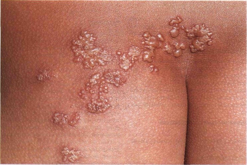 Как вылечить грибковое заболевание кожи