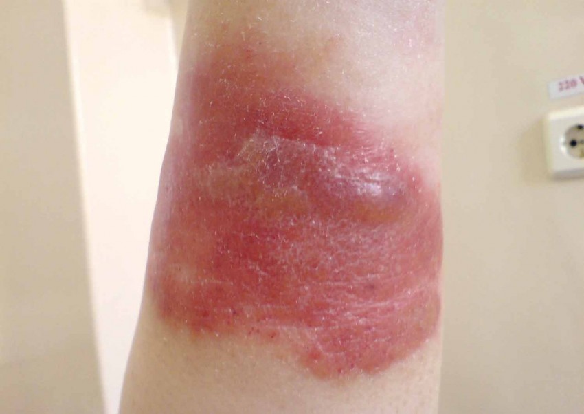 Аллергия грибок на коже фото thumbnail