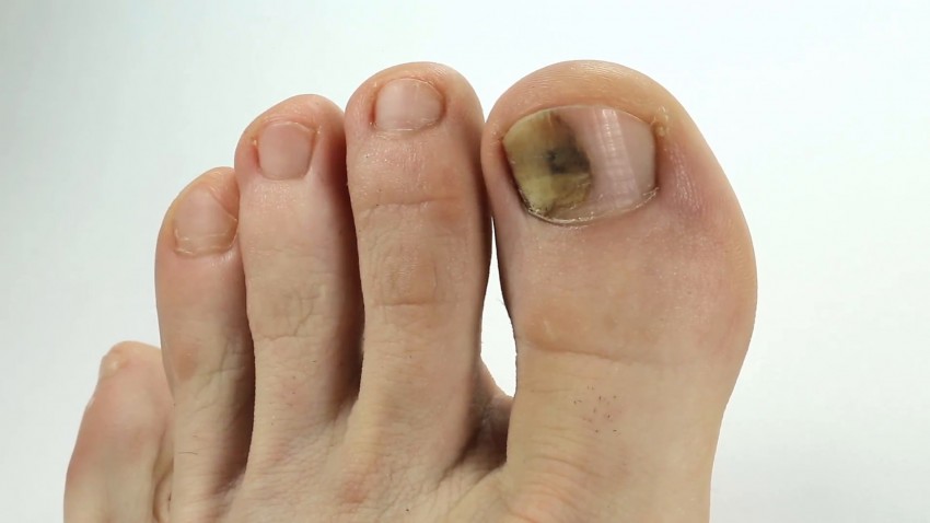 Грибок ногтей - какой врач лечит, основные признаки. Профилактика заболевания, 110 фото и видео восстановления ногтей