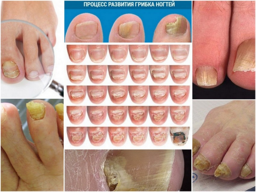 Грибок ногтей - какой врач лечит, основные признаки. Профилактика заболевания, 110 фото и видео восстановления ногтей