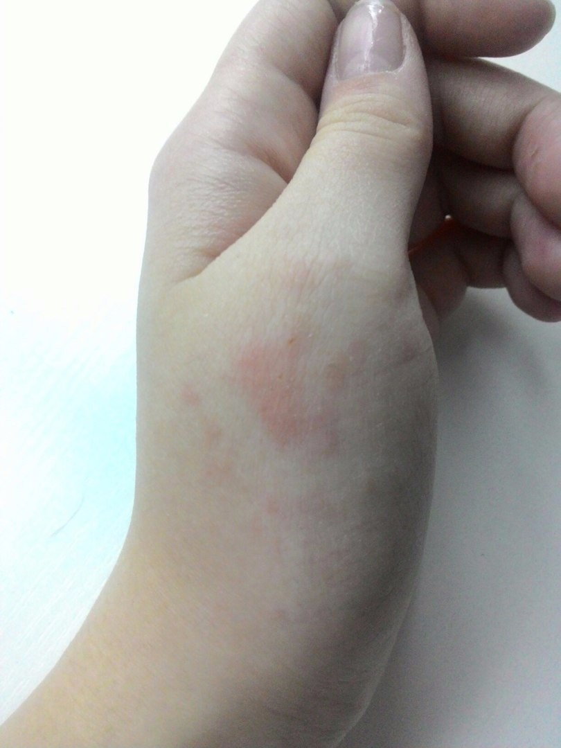 Красный плоский лишай контактный аллергический дерматит