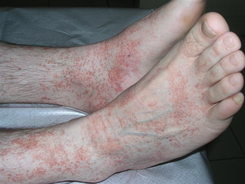 Аллергический дерматит плоский лишай