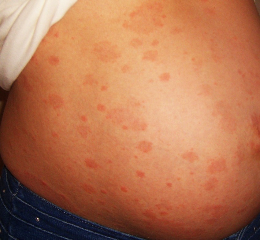 Аллергический дерматит и лишай