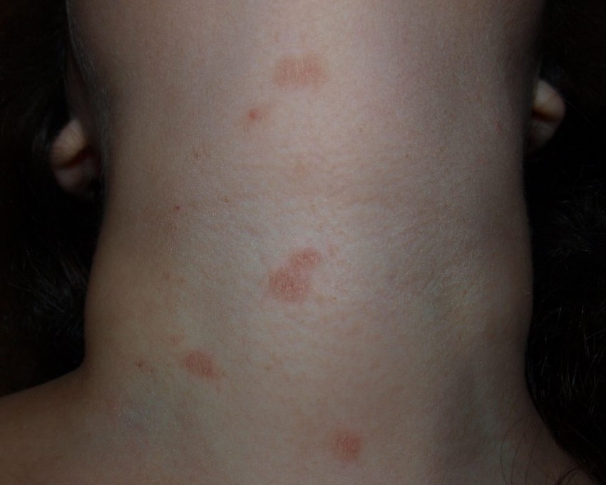 Отличие дерматита от лишая у детей