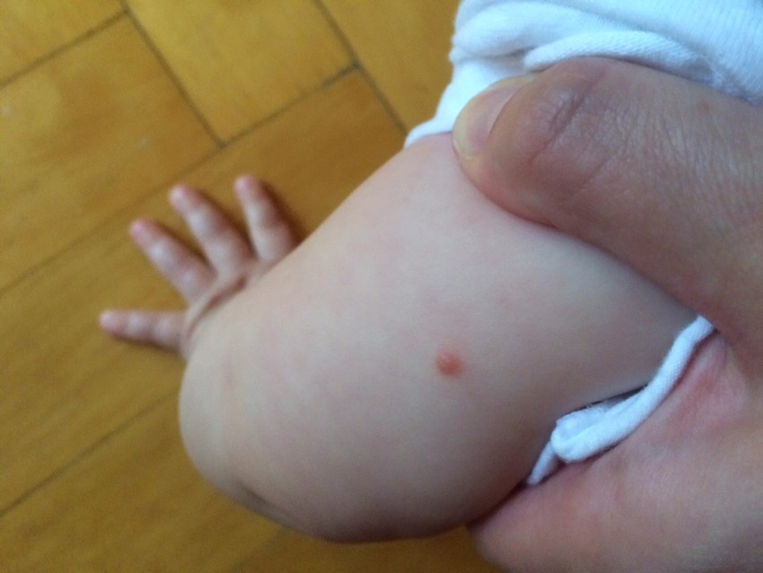Ребенку 1 год сыпь как прыщики