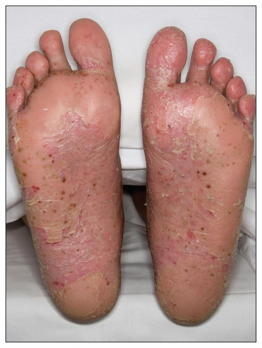 Псориаз фото симптомы и лечение у взрослых на ногах
