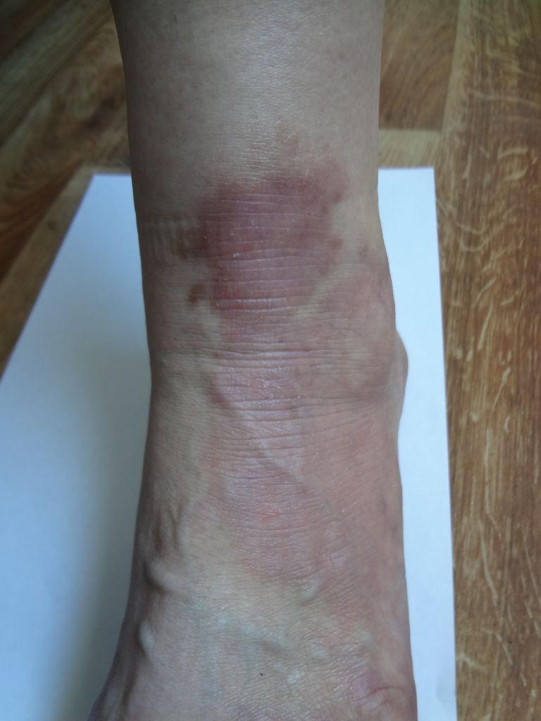 Как выглядит псориаз на ногах лечение