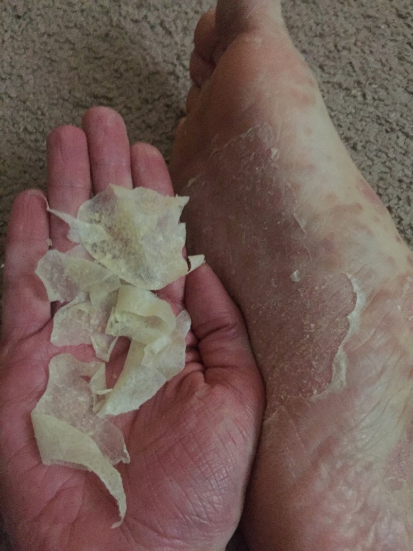 Псориаз на подошве ног фото лечение