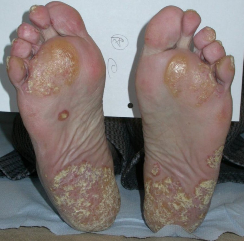 Псориаз на ногах фото начальной стадии лечение thumbnail