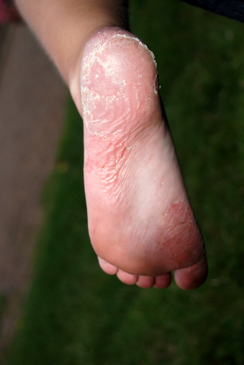 Заболевания кожи ног псориаз