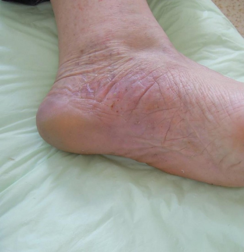 Псориаз на ногах причины и лечение фото