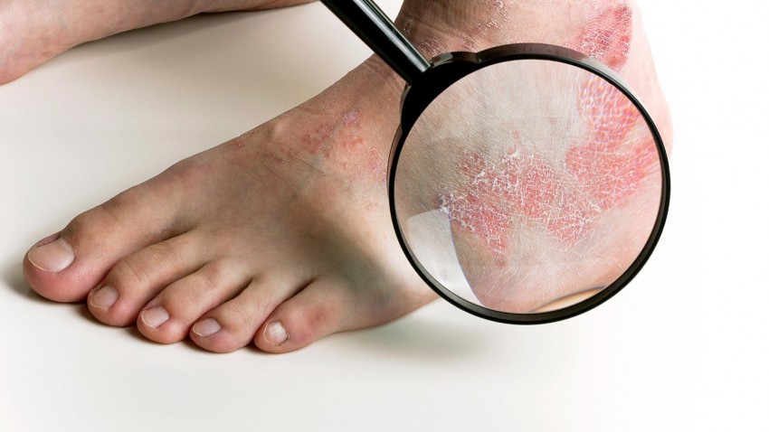 Псориаз фото симптомы и лечение у взрослых на ногах