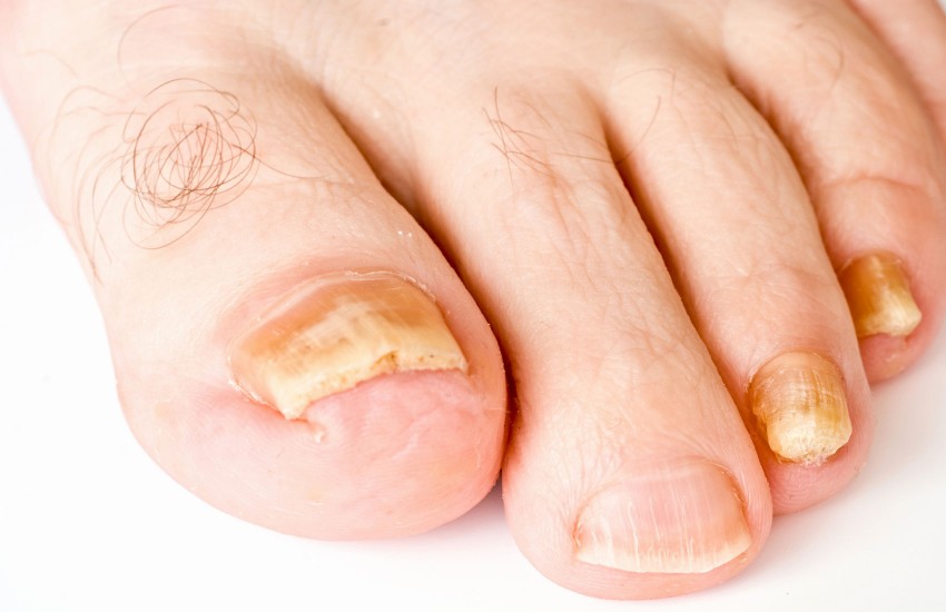 Заболевания кожи ног псориаз