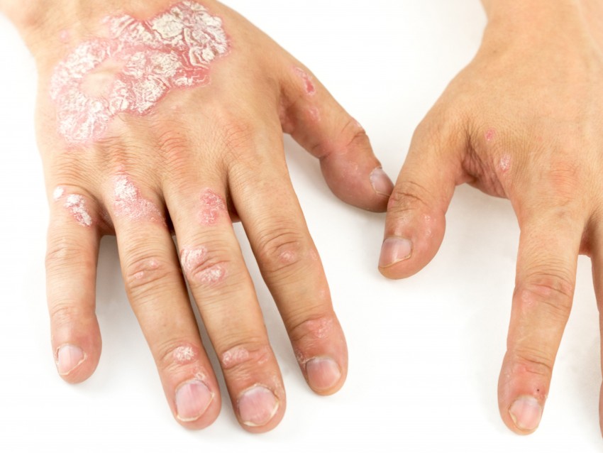 Болезнь кожи рук псориаз