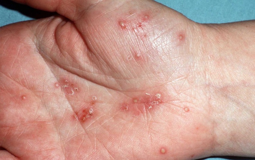 Псориаз заболевания кожи рук в руки
