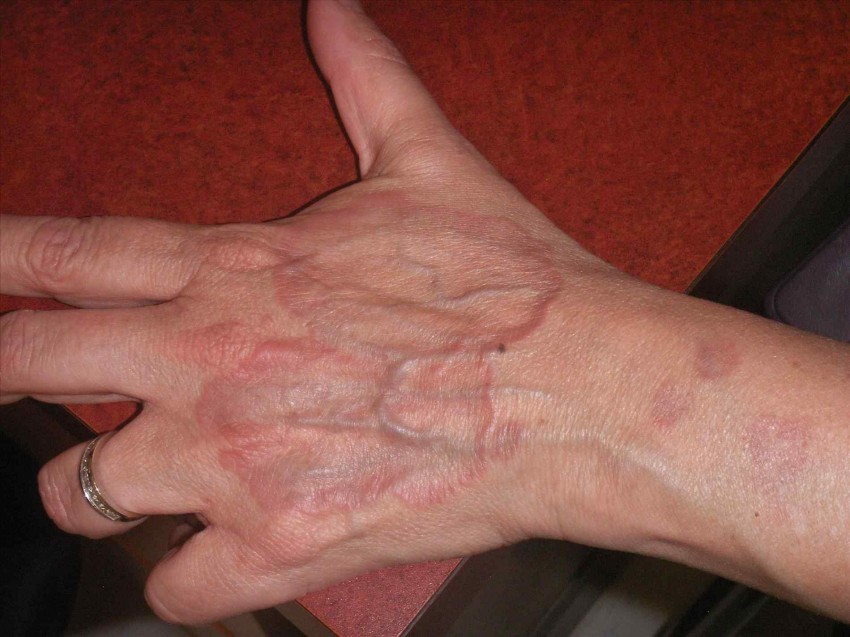 Псориаз на коже рук