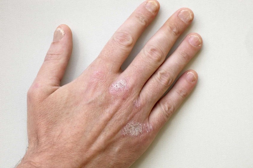 Болезнь кожи рук псориаз