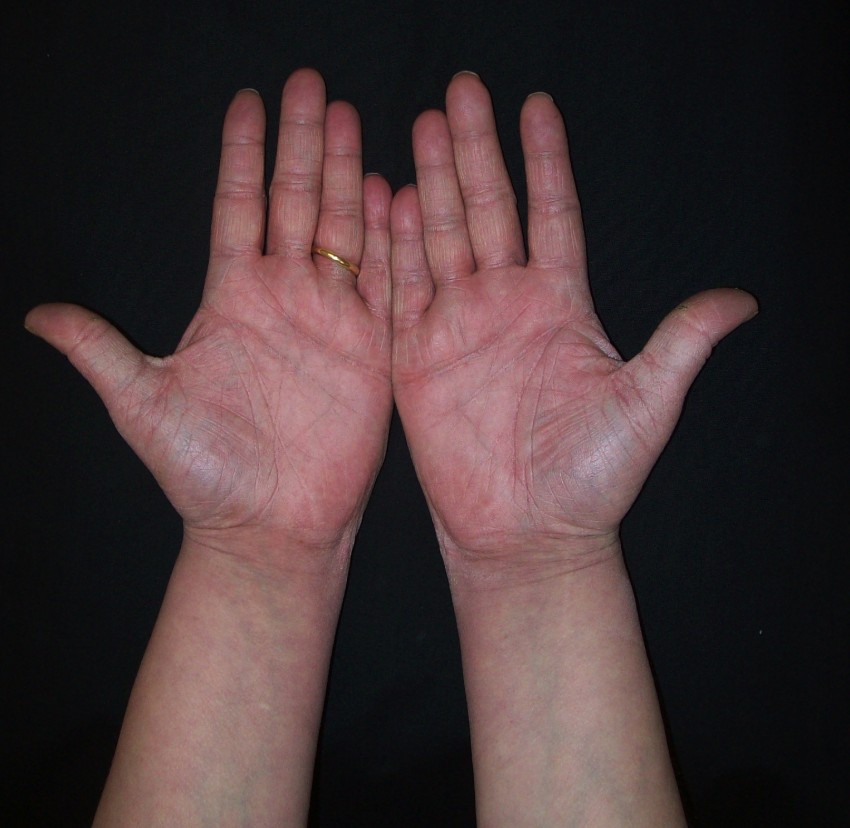 Псориаз заболевания кожи рук в руки