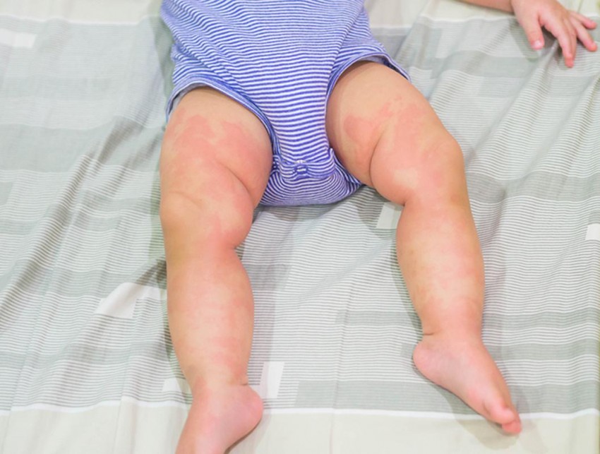 Псориаз у детей - начальные стадии, признаки развития, симптомы и варианты лечения. 110 фото и меры профилактики