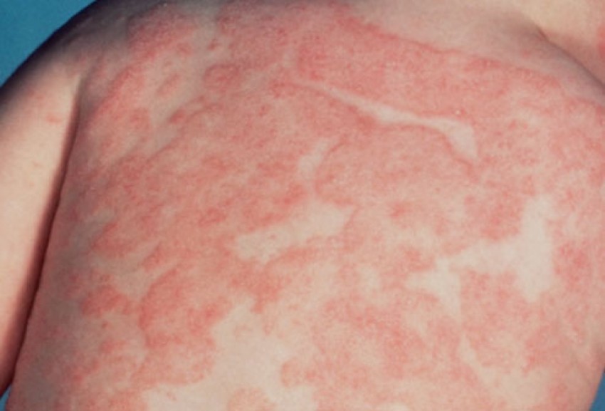 Аллергия на коже: виды, проявления, симптомы и варианты лечения. 140 фото и видео советы по выявлению аллергена
