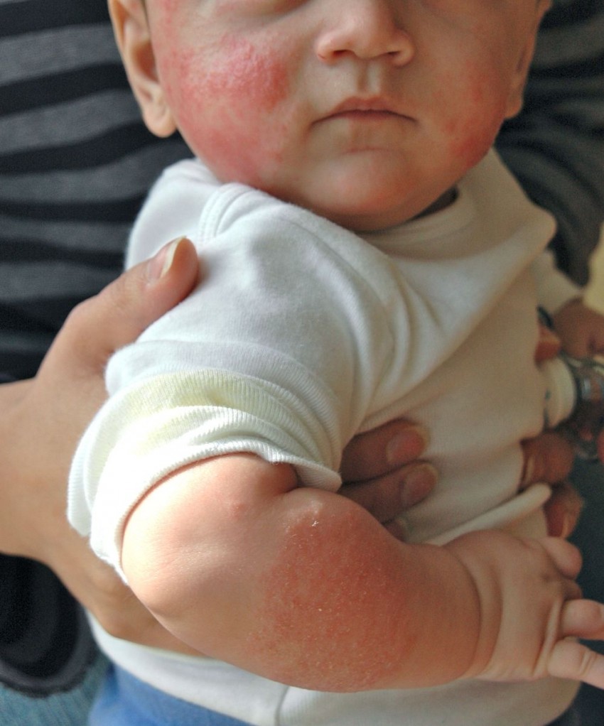 Аллергия на коже: виды, проявления, симптомы и варианты лечения. 140 фото и видео советы по выявлению аллергена