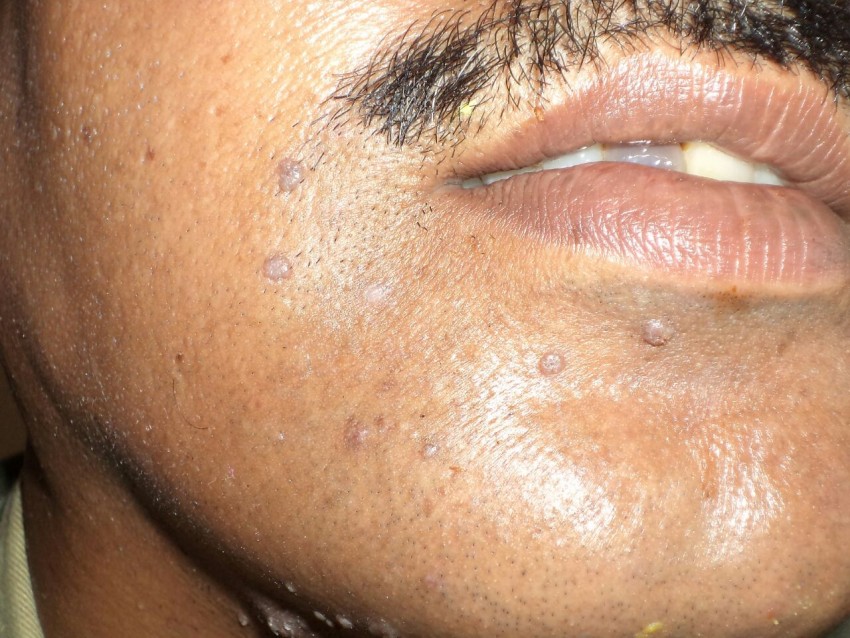 Виды бородавка на лице лечение