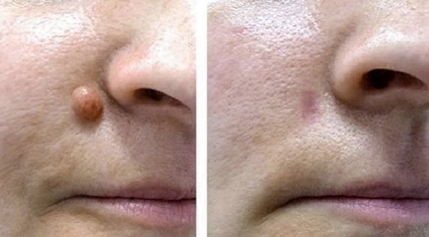 Бородавки на носу у женщин фото thumbnail