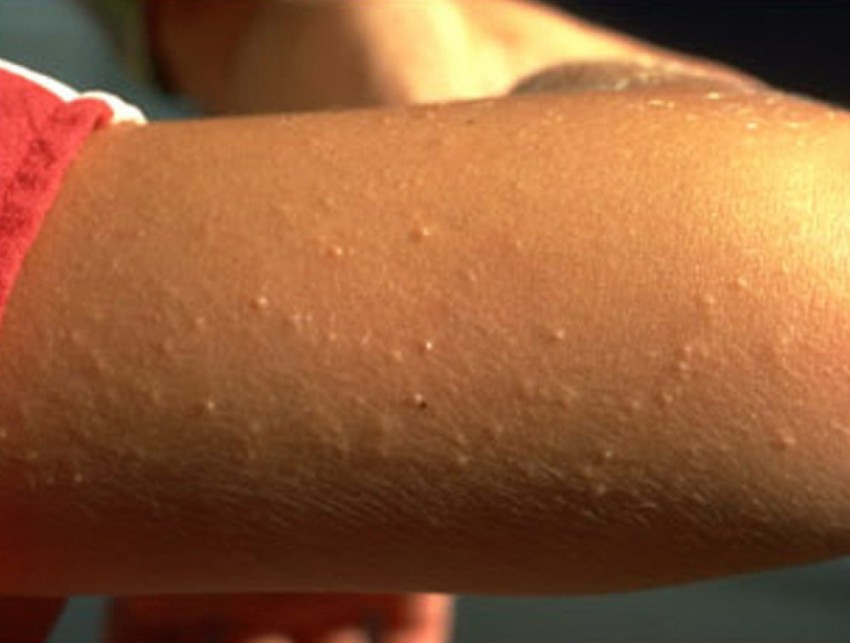 Гусиная кожа: причины появления, методы избавления и основные симптомы заболевания (120 фото и видео)