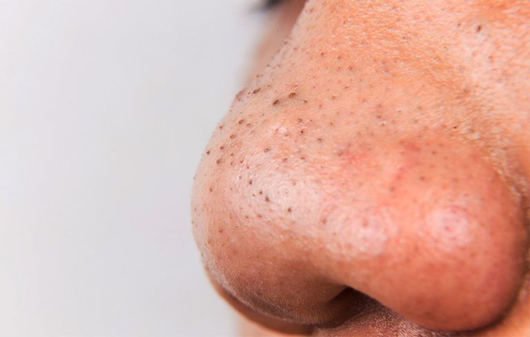 Прыщ на носу - диагностика, причины появления и методика лечения. Подробное описание ухода за кожей (105 фото + видео)