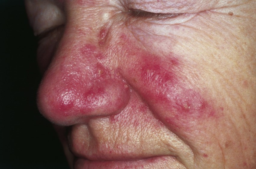 Прыщ на носу - диагностика, причины появления и методика лечения. Подробное описание ухода за кожей (105 фото + видео)