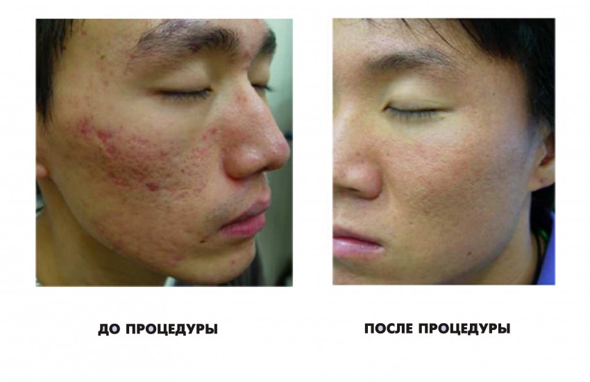 Рубцы от прыщей: средства для устранения шрамов и советы по восстановлению кожи медицинскими и народными средствами (110 фото)