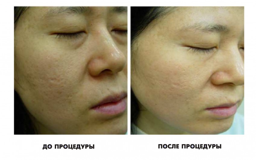 Рубцы от прыщей: средства для устранения шрамов и советы по восстановлению кожи медицинскими и народными средствами (110 фото)